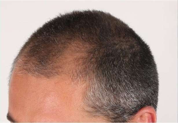 découvrez notre guide complet sur le traitement prp pour cheveux, ses avantages, déroulement, et conseils pour retrouver une chevelure dense et saine.