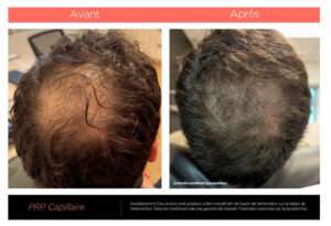 Traitement prp cheveux : tout savoir sur cette technique régénératrice