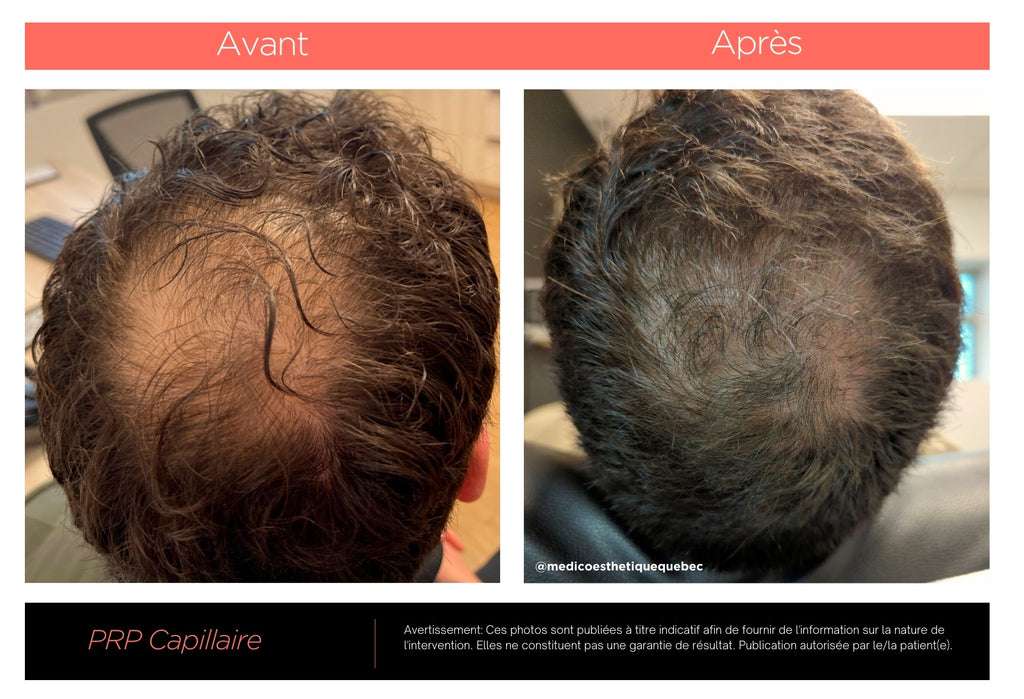 découvrez notre guide complet sur le traitement prp pour les cheveux, une solution naturelle pour stimuler la croissance capillaire et lutter contre la chute de cheveux.