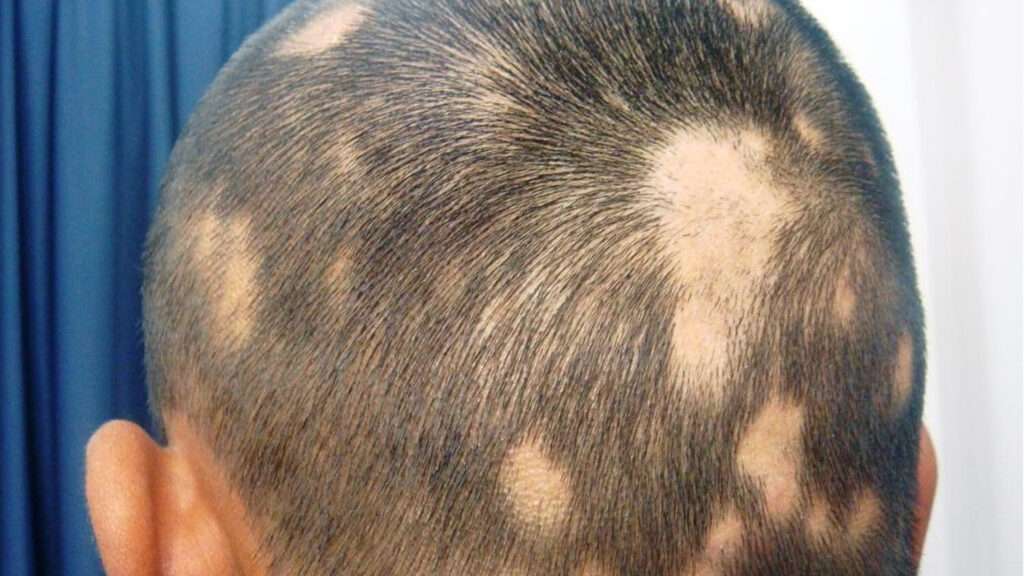 découvrez tout sur l'alopécie : causes, symptômes et solutions efficaces pour lutter contre la perte de cheveux.