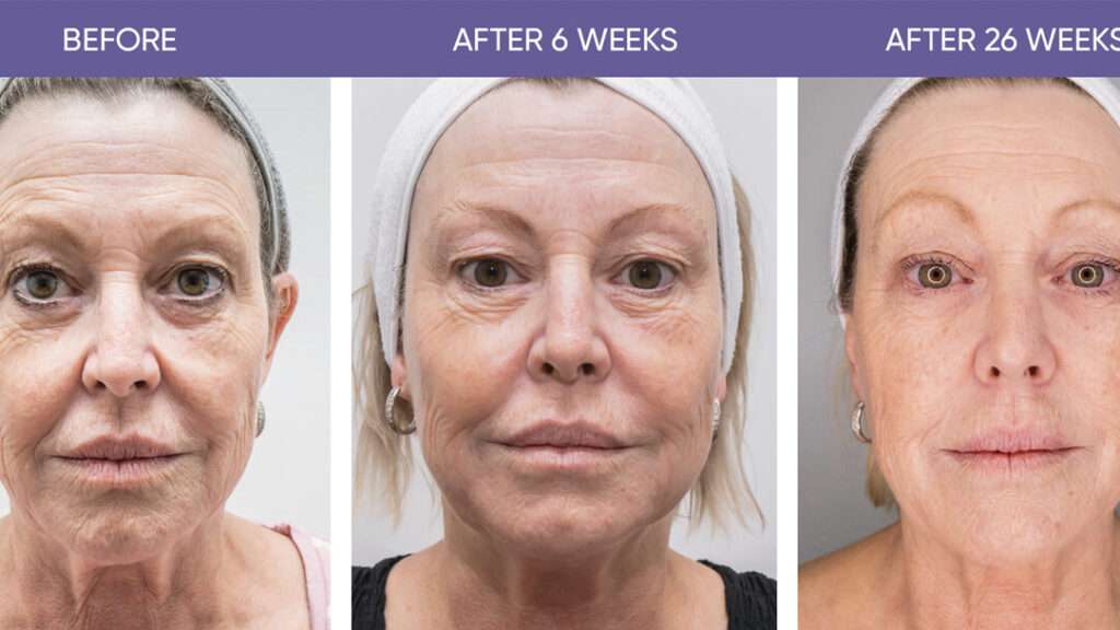 découvrez le hifu visage, une technologie innovante pour un lifting naturel sans chirurgie, raffermissant et rajeunissant la peau en profondeur.