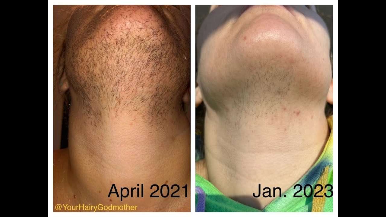 découvrez nos solutions efficaces d'épilation faciale permanente pour un visage lisse et sans poils, adaptées à tous types de peau.