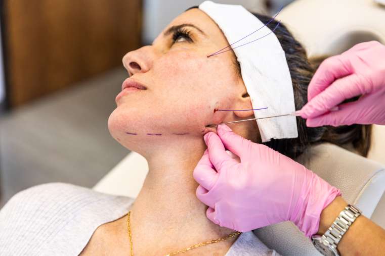découvrez les lifts par fils tenseurs, une technique innovante pour raffermir et rajeunir la peau sans chirurgie. résultats naturels et rapides.