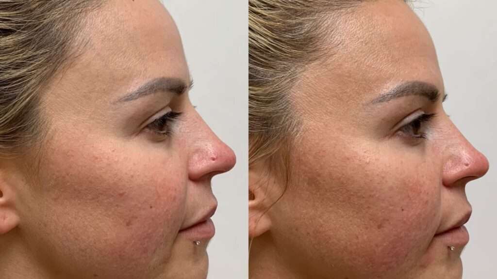découvrez les fils tenseurs, une technique esthétique innovante pour un lifting du visage naturel et sans chirurgie, améliorant fermeté et contours.
