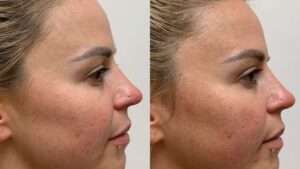 Tout savoir sur les fils tenseurs pour le visage : efficacité et utilisation