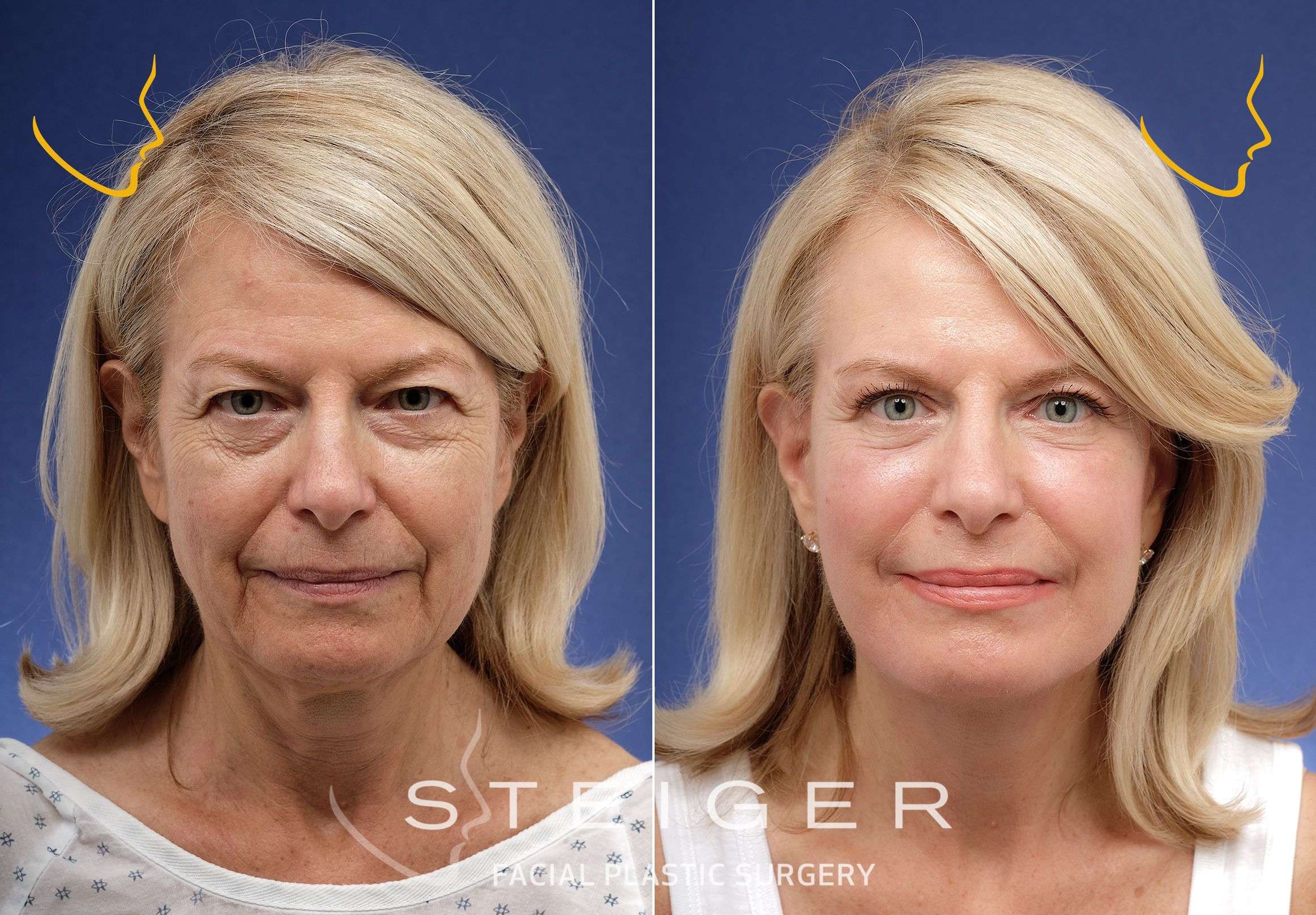 découvrez tout sur le facelift : procédure, avantages, résultats et conseils pour un rajeunissement du visage naturel et harmonieux.