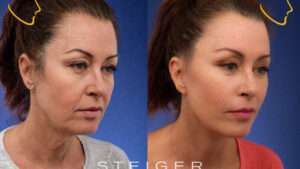 Tout savoir sur le lifting visage : techniques, résultats et conseils